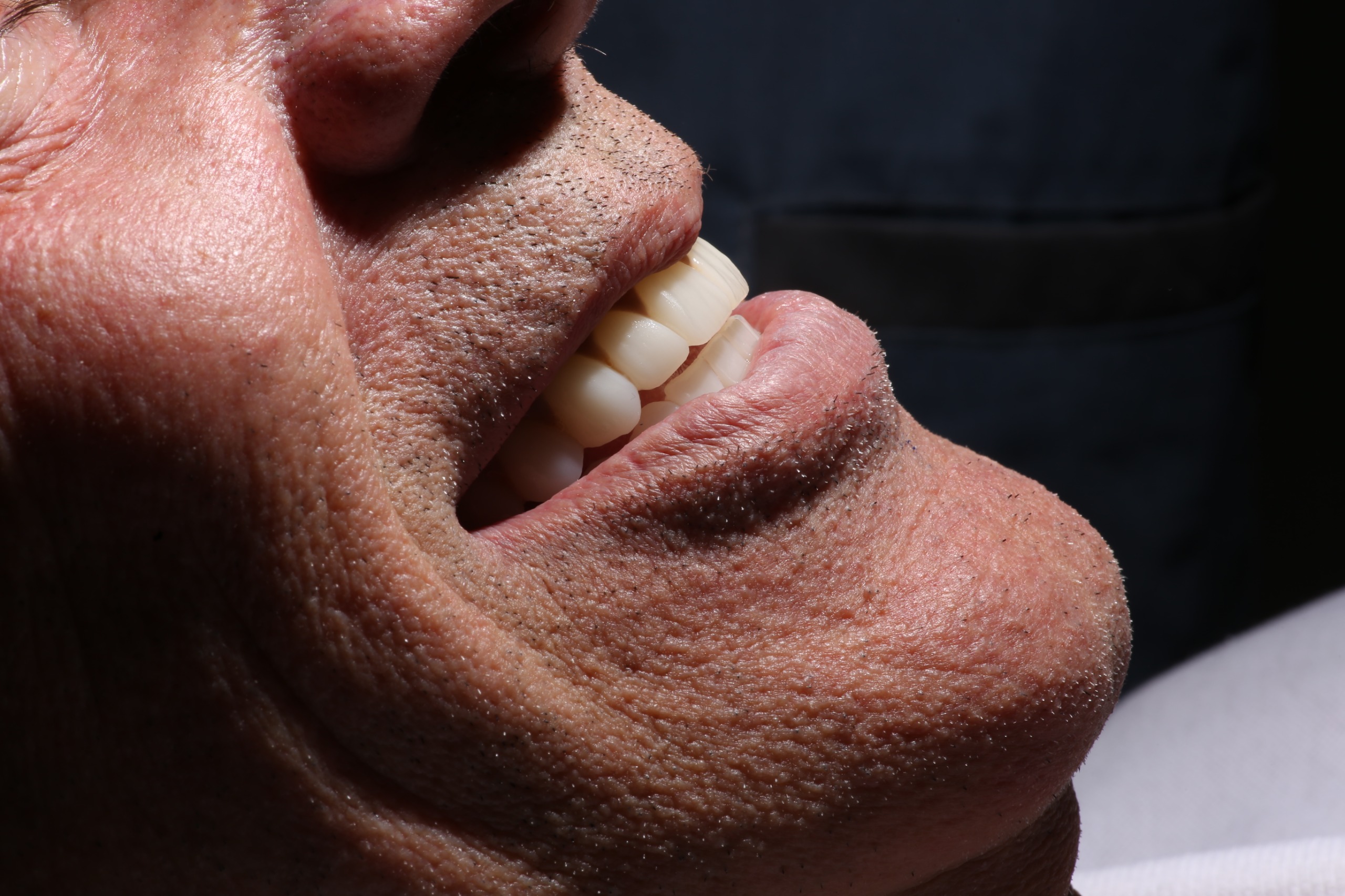 Rehabilitación estética protésica final en Dental Center Córdoba